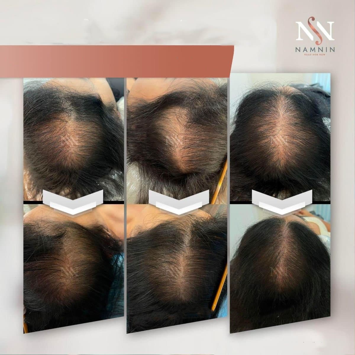 hair mesotherapy