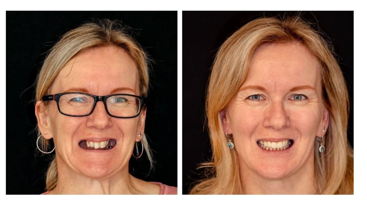 crown lengthening