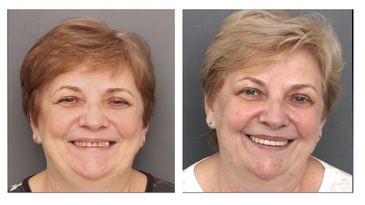 crown lengthening