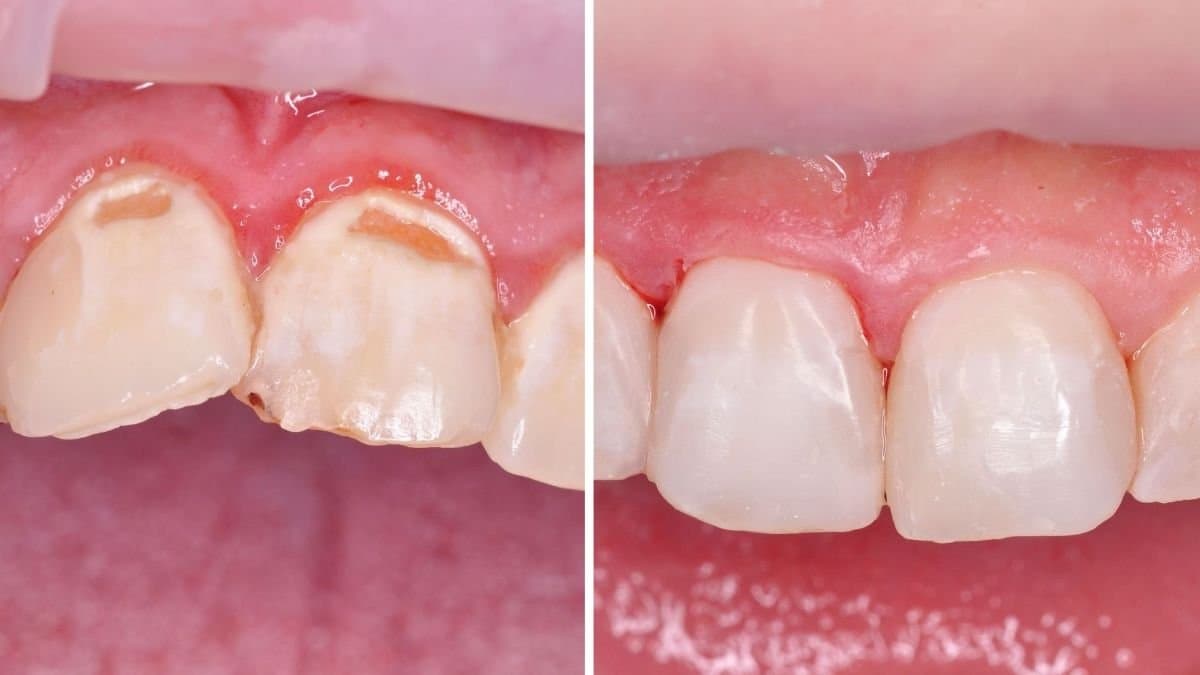 crown lengthening
