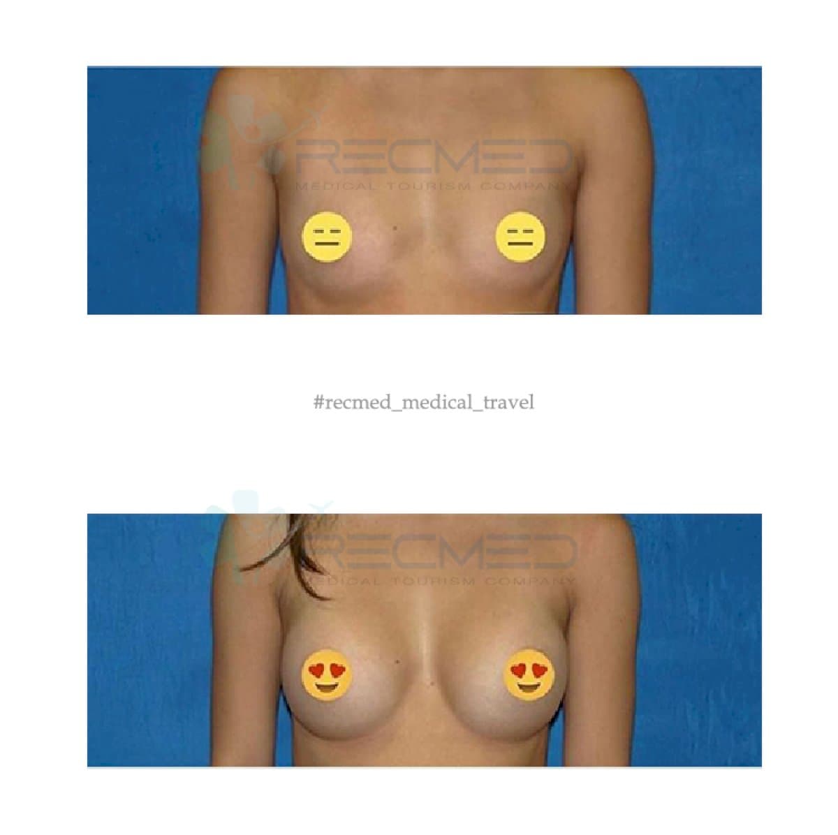 breast augmentation