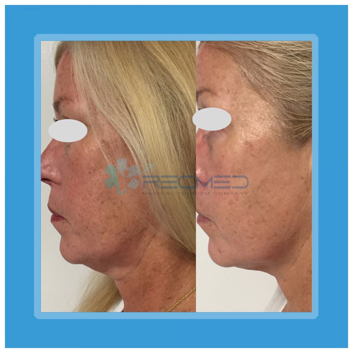 neck lift