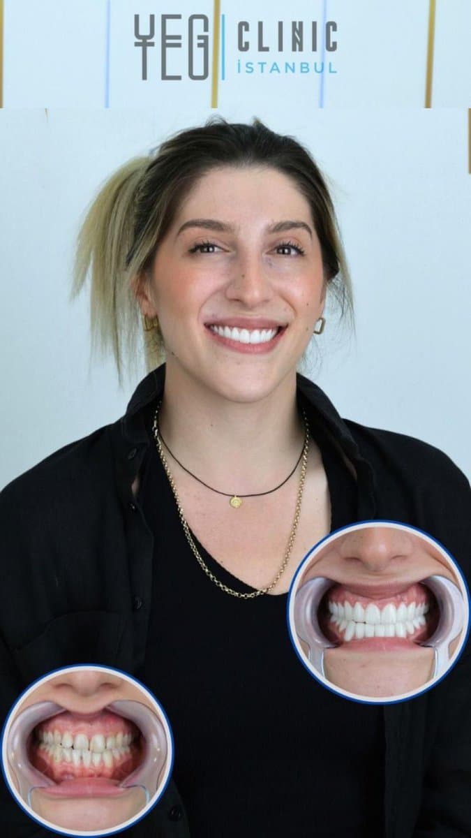 All-on-2 dental implants
