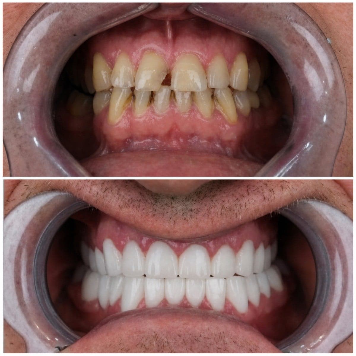 denture