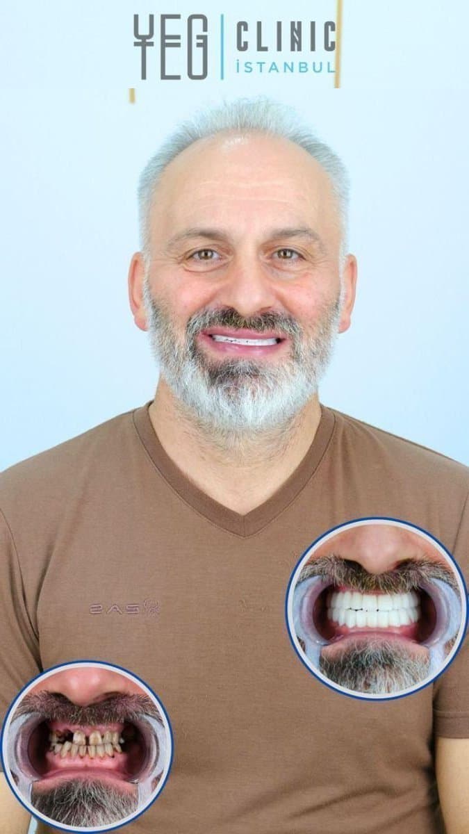 All-on-6 dental implants