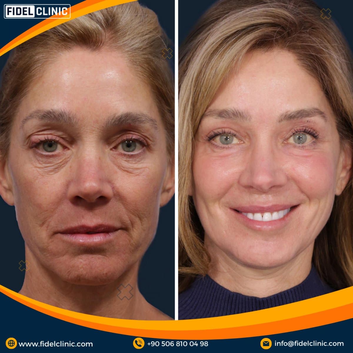 blepharoplasty