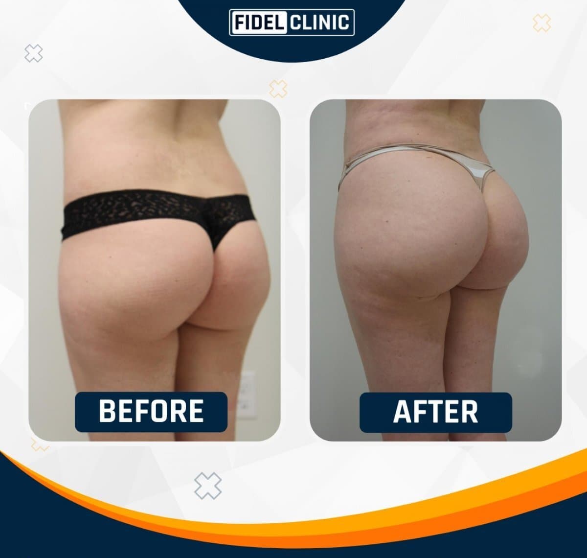 Brazilian Butt Lift