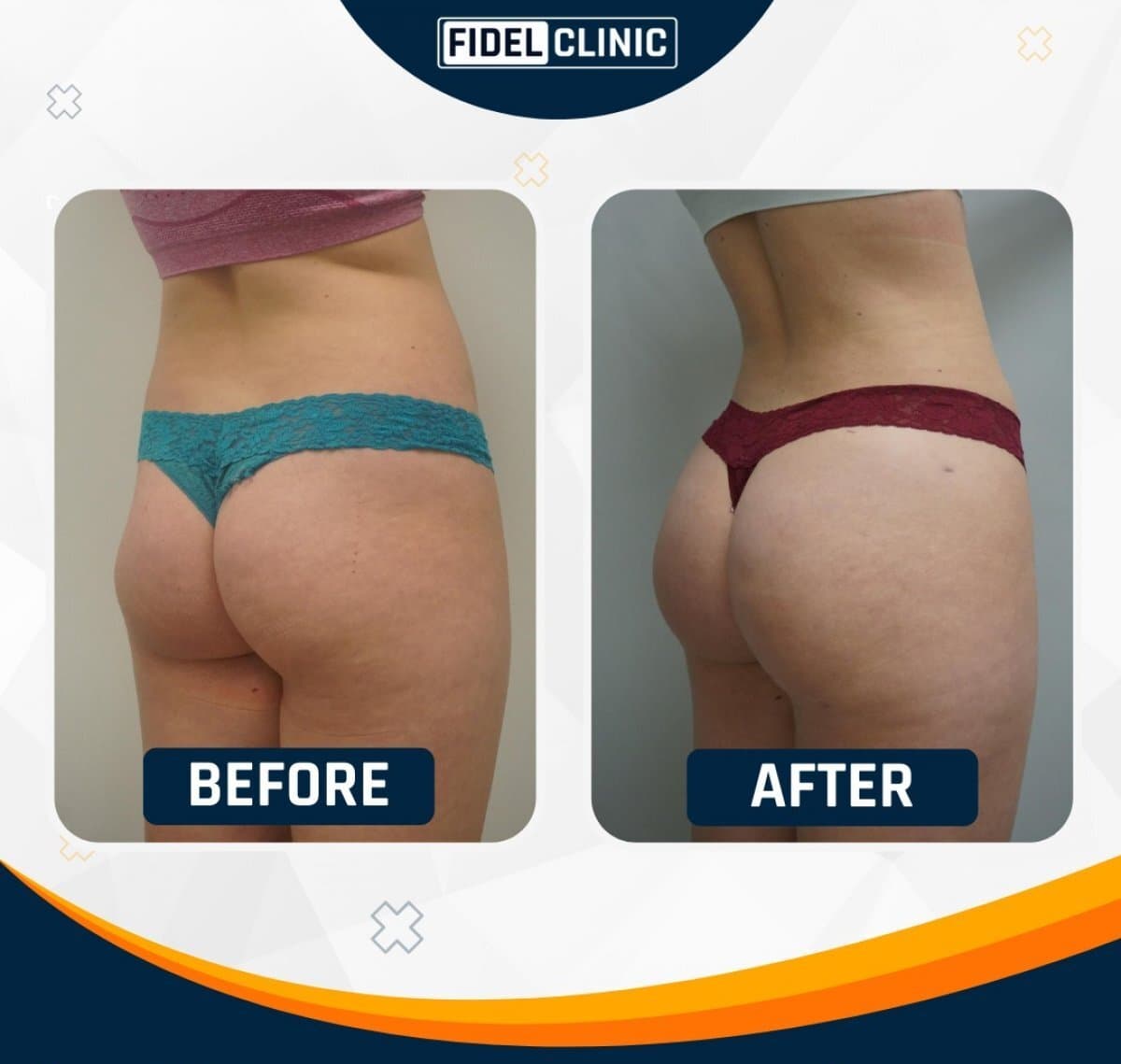 Brazilian Butt Lift