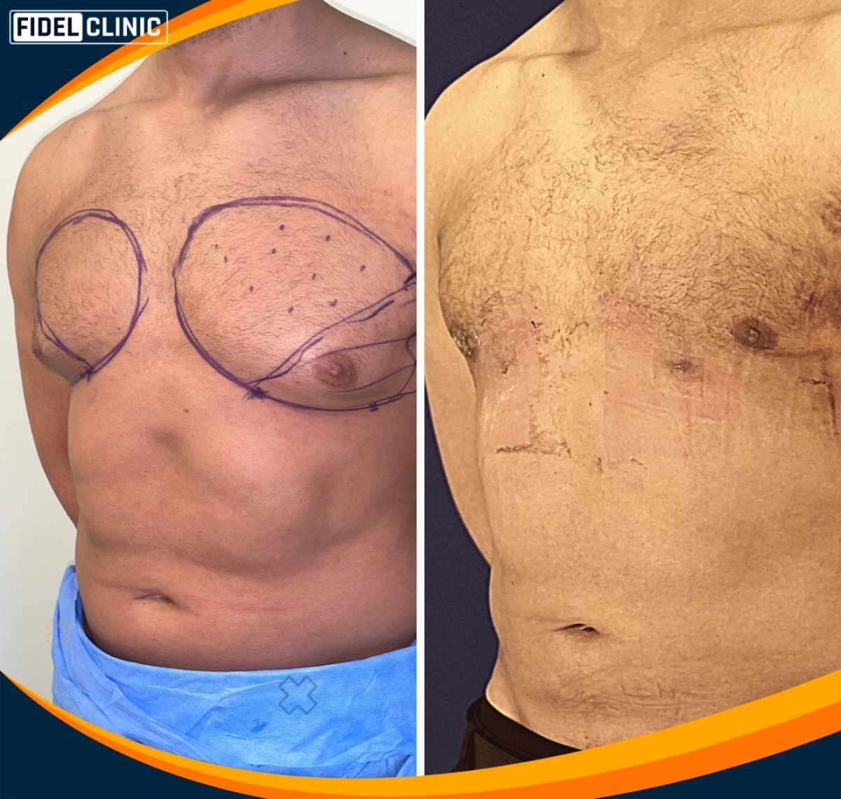 gynecomastia surgery