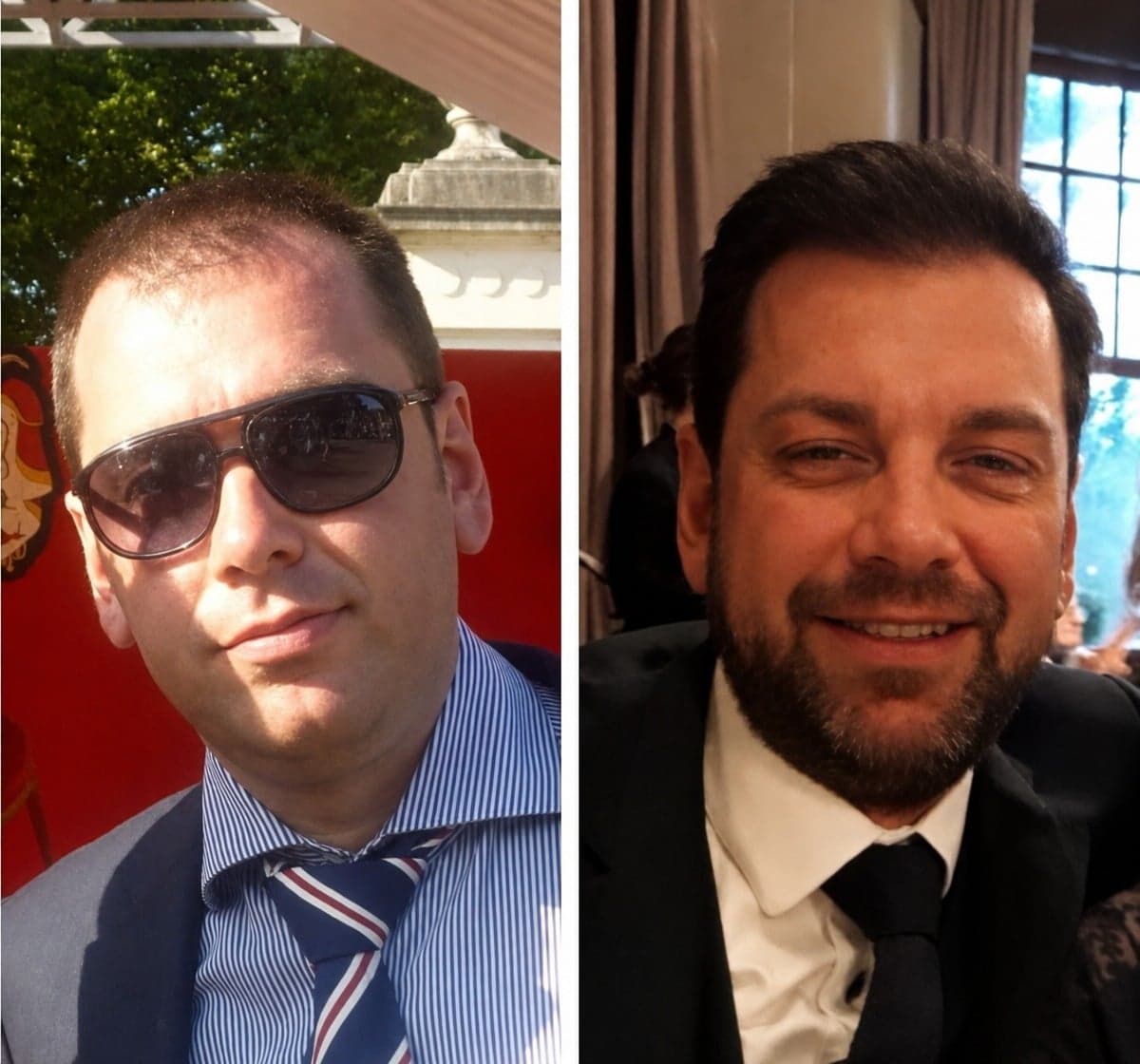 DHI hair transplant