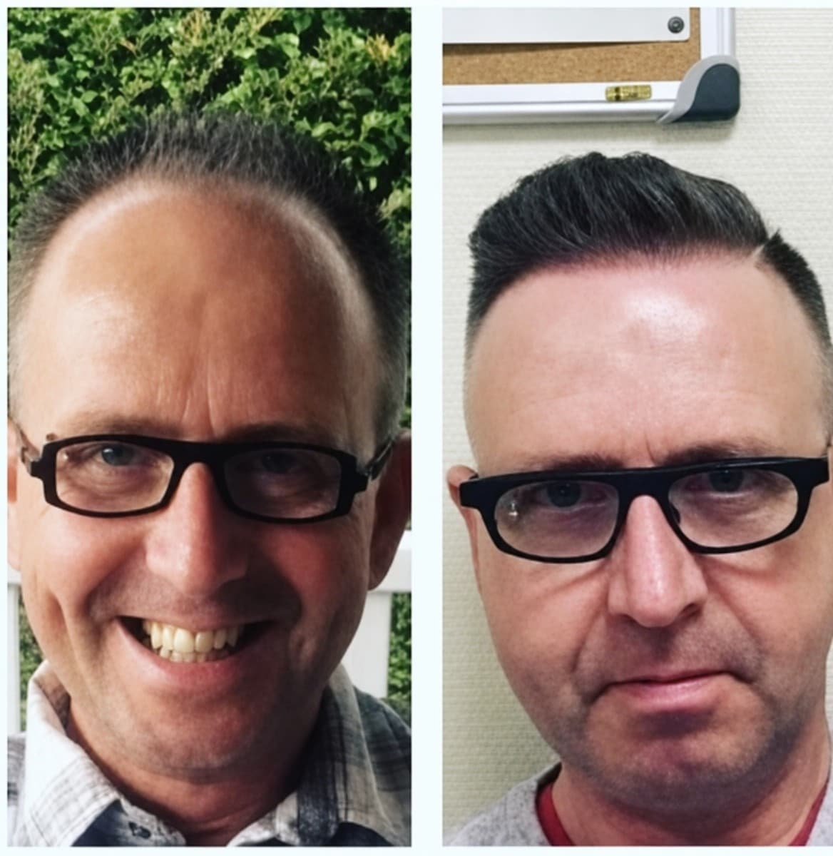 DHI hair transplant