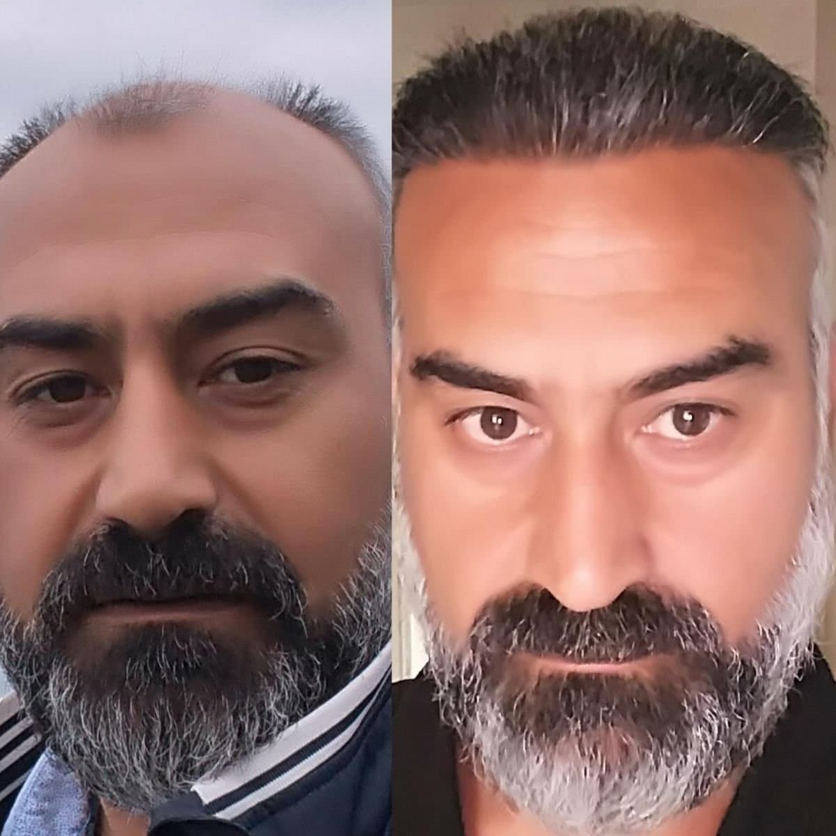 DHI hair transplant