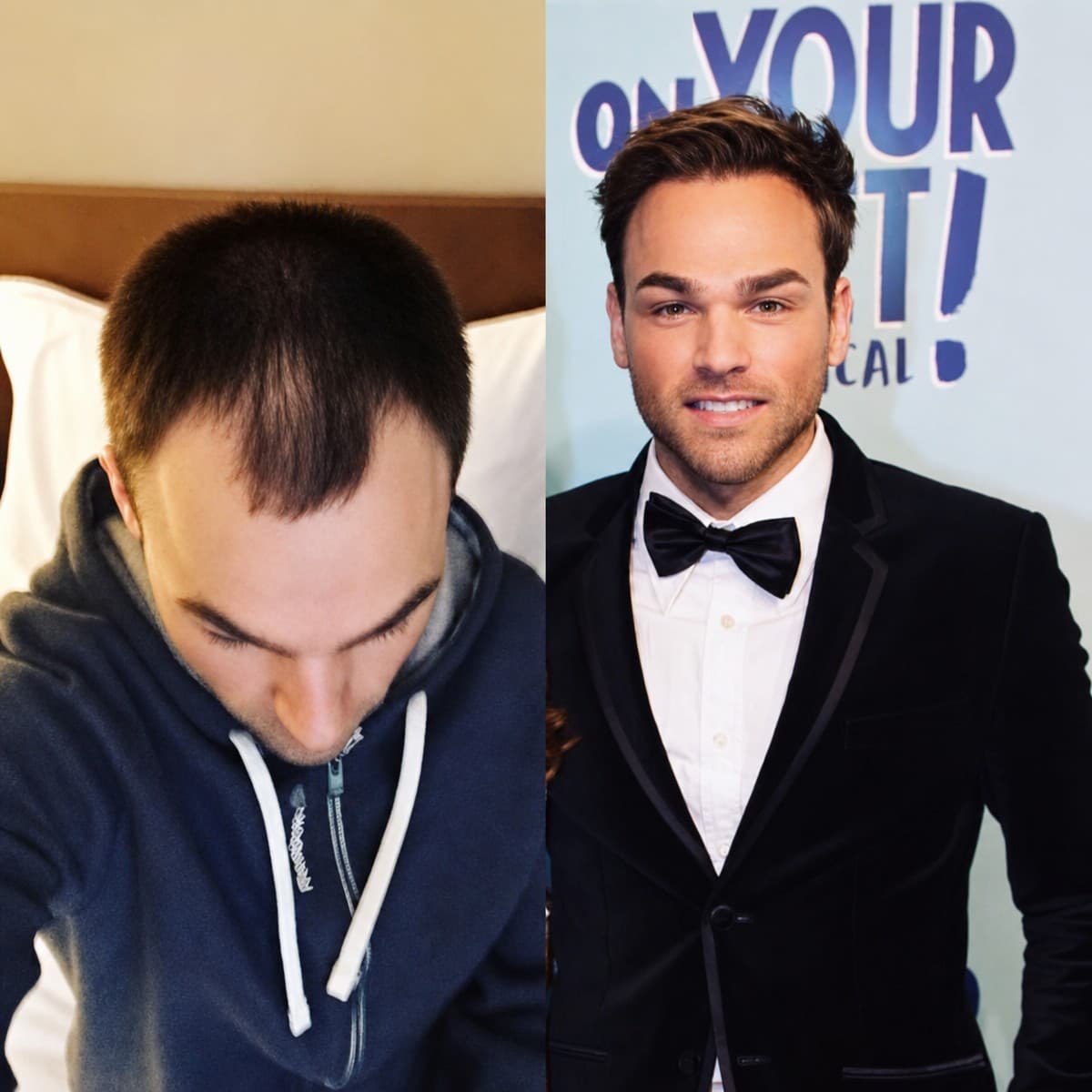 DHI hair transplant
