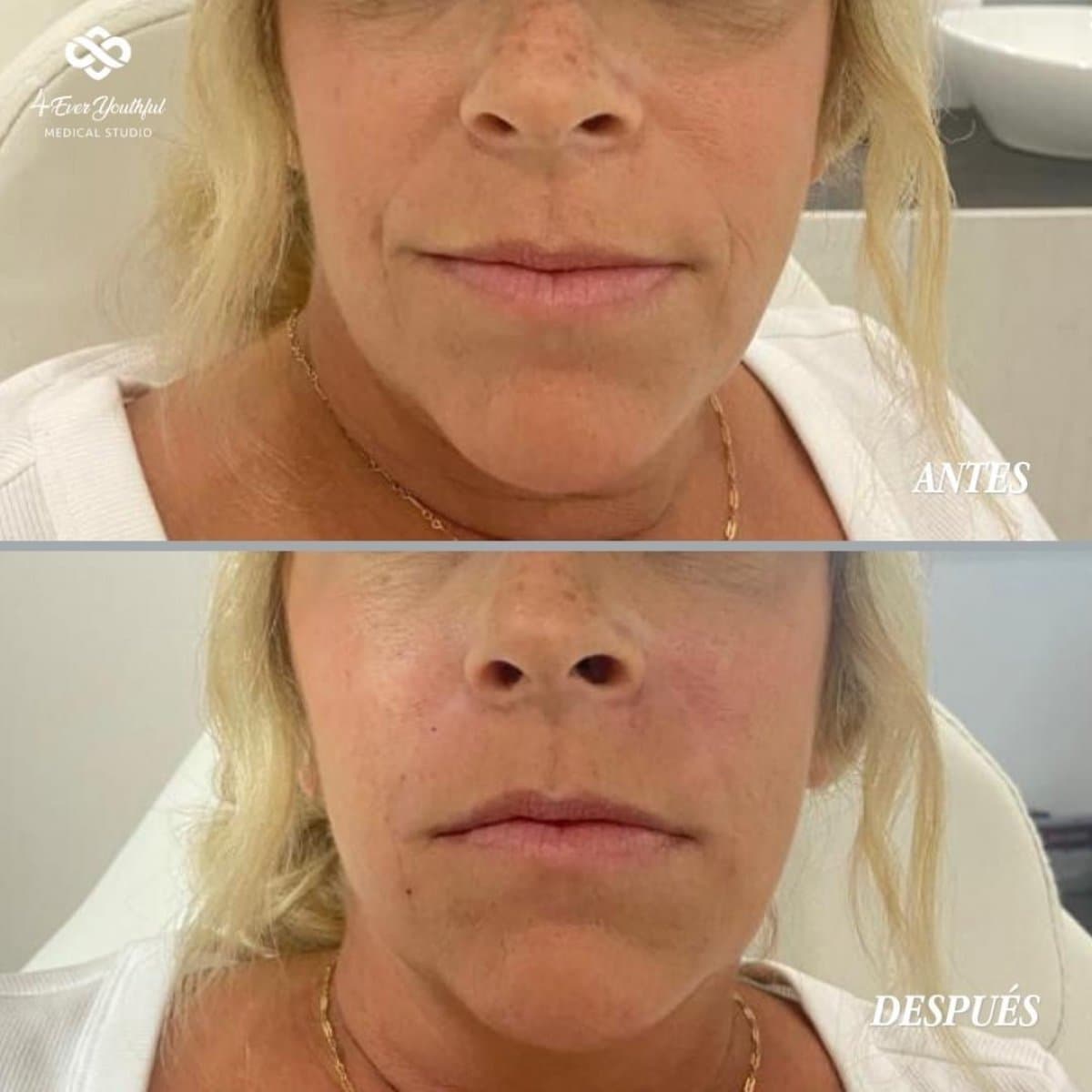 Botox injections