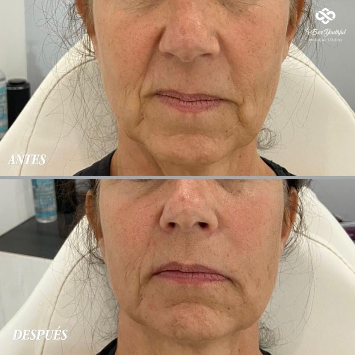 Botox injections