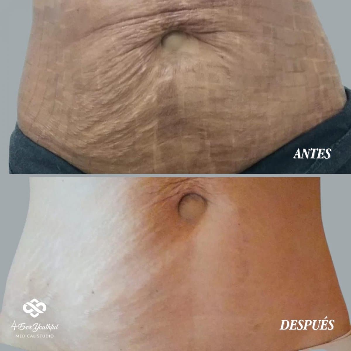 laser skin resurfacing
