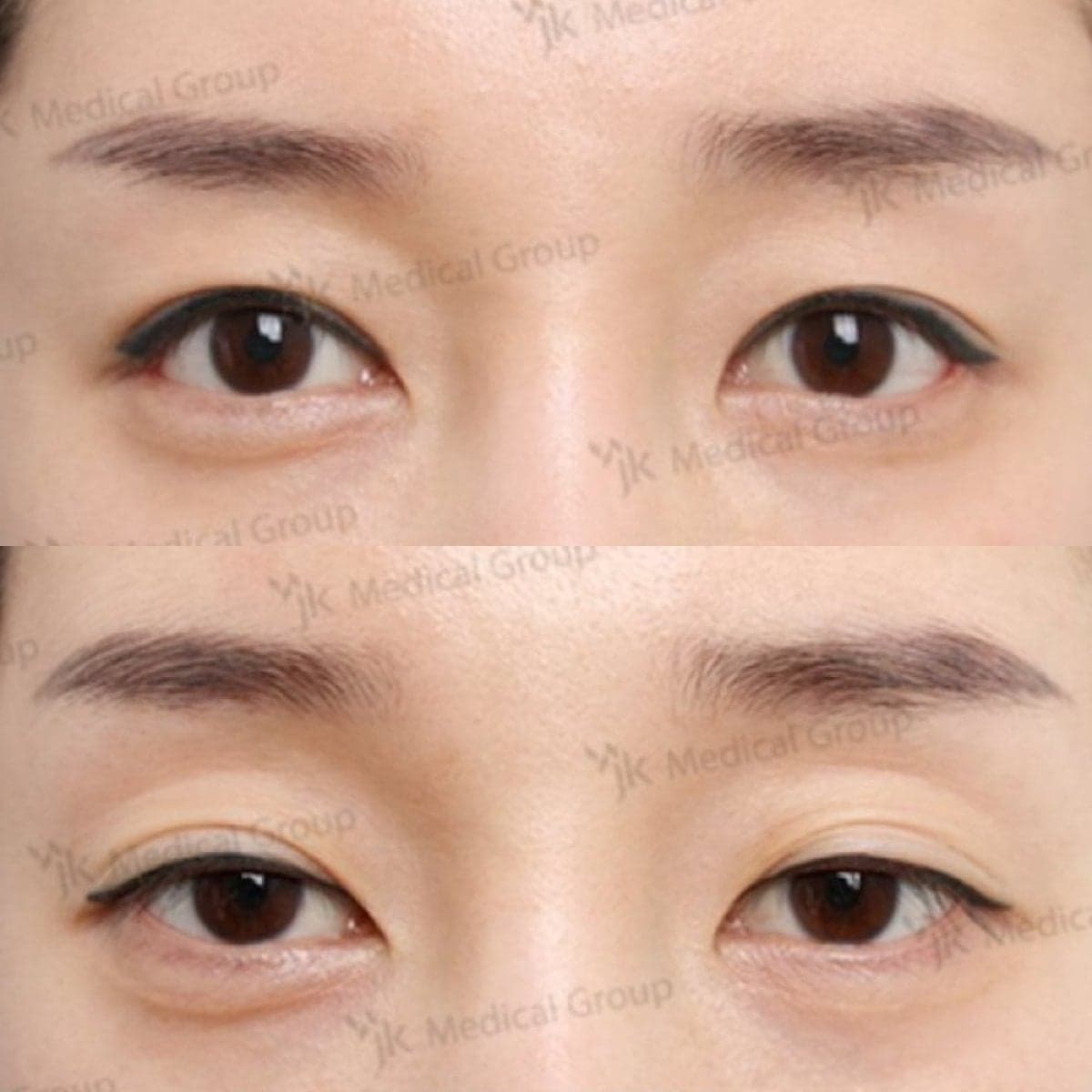 lazy eyelid surgery