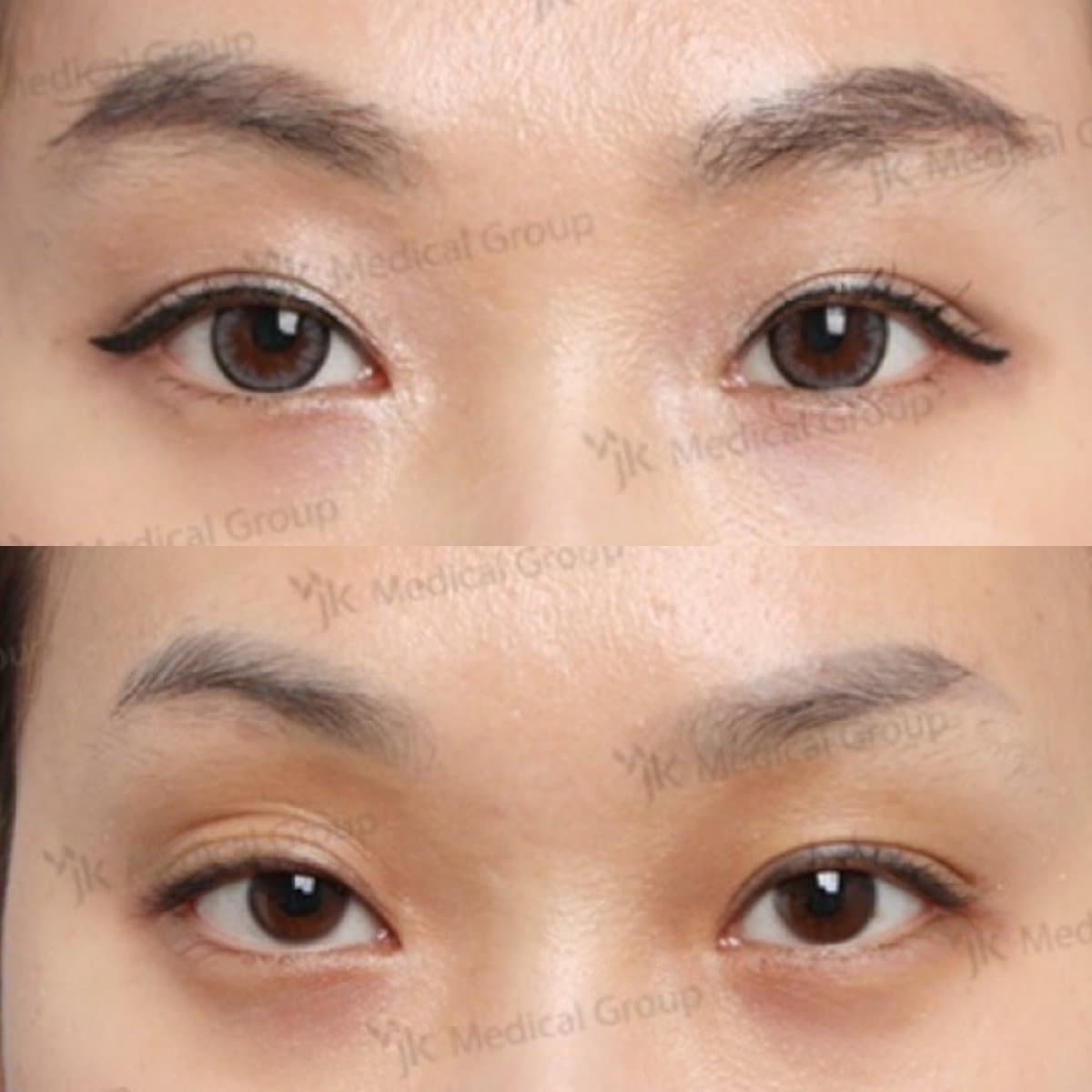 lazy eyelid surgery