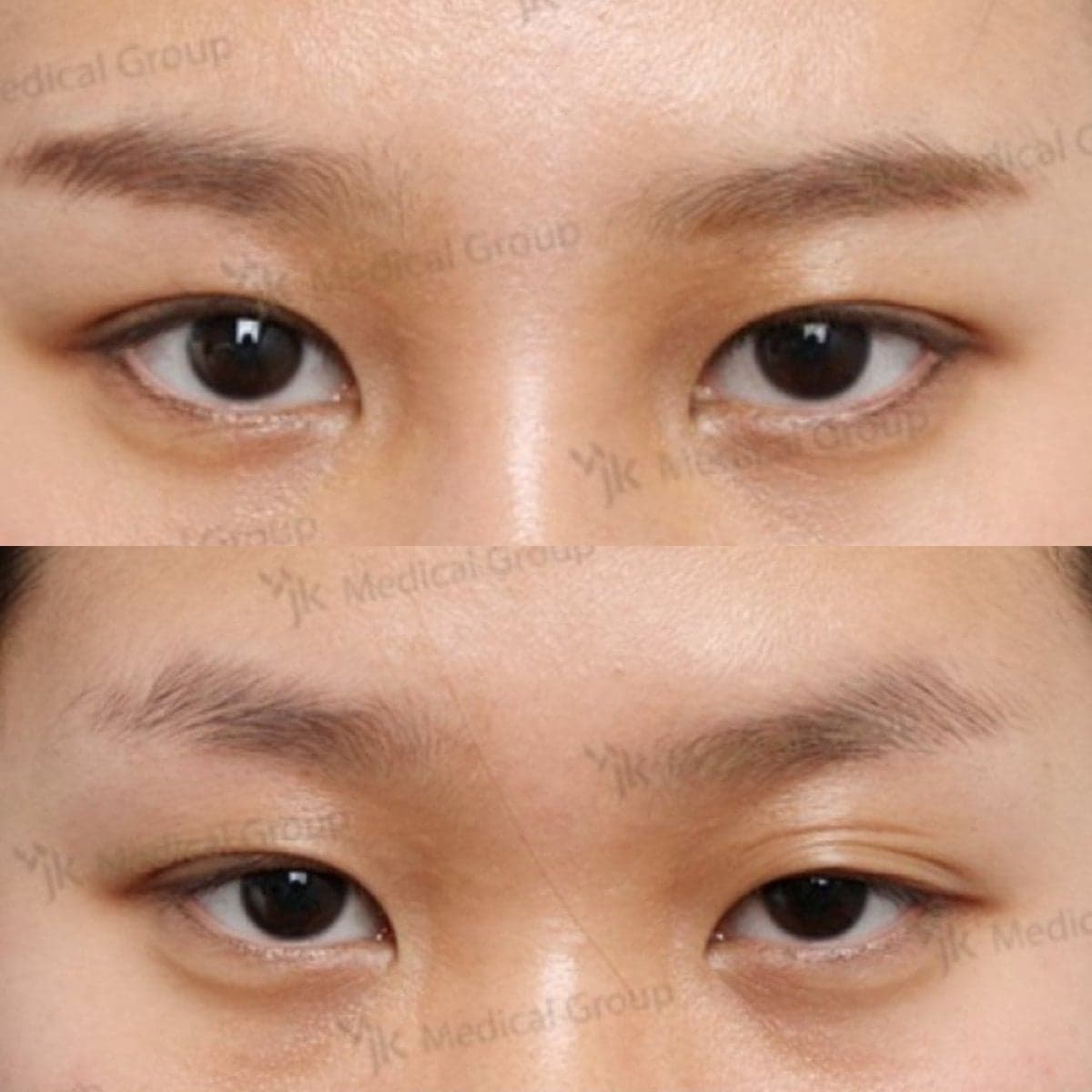 lazy eyelid surgery