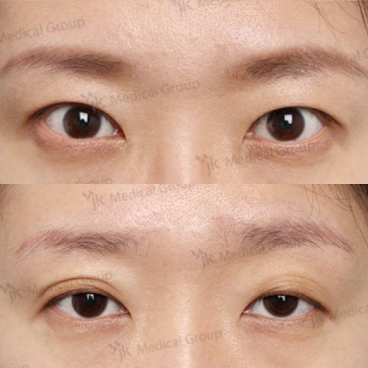 lazy eyelid surgery