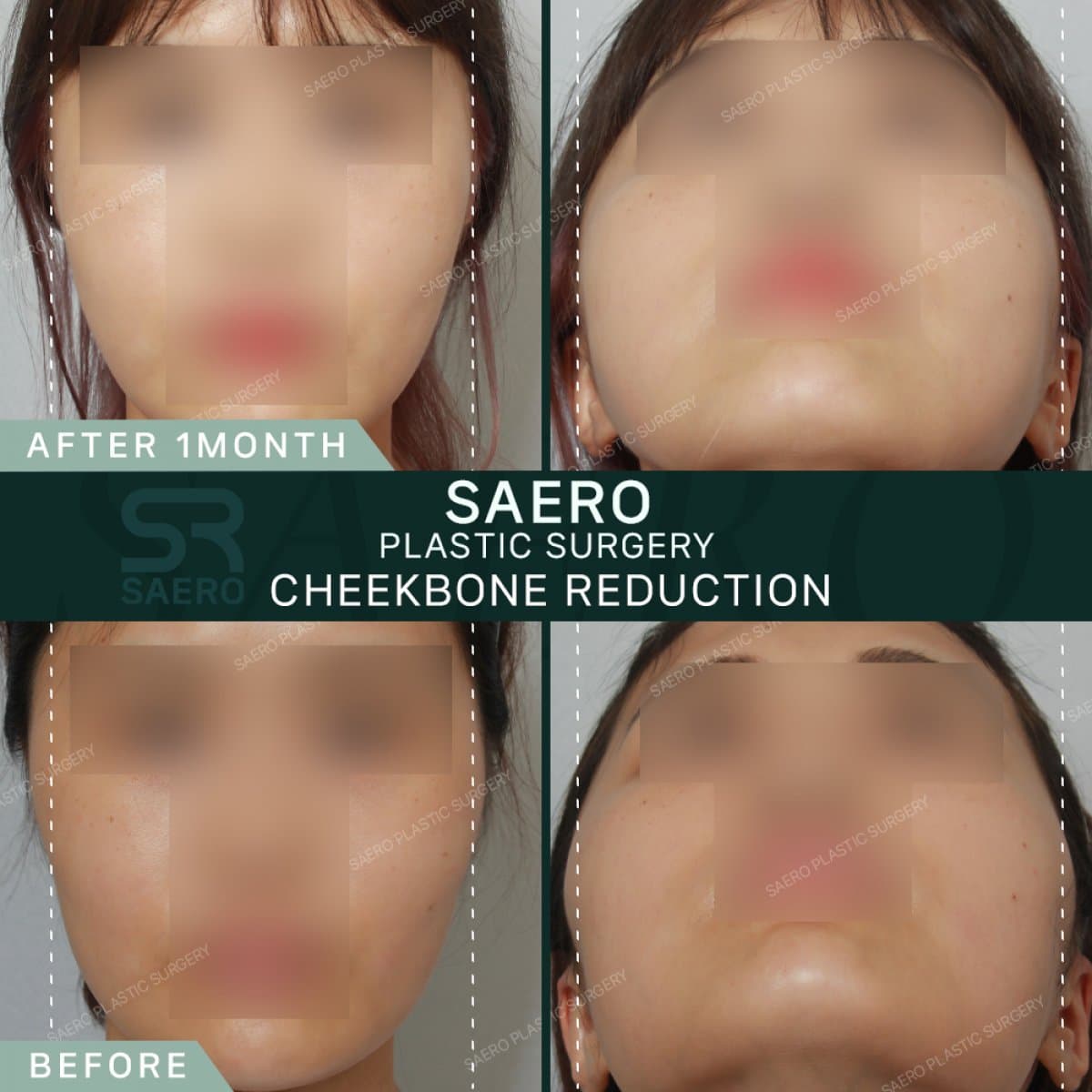 cheekbone reduction