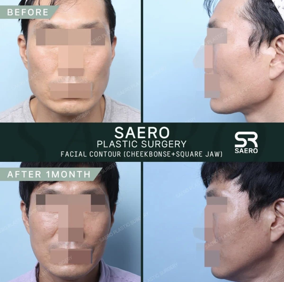 cheekbone reduction and jaw contouring
