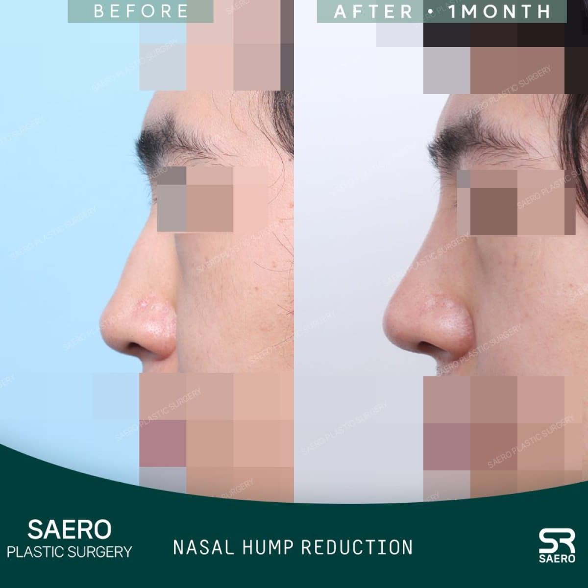 open rhinoplasty