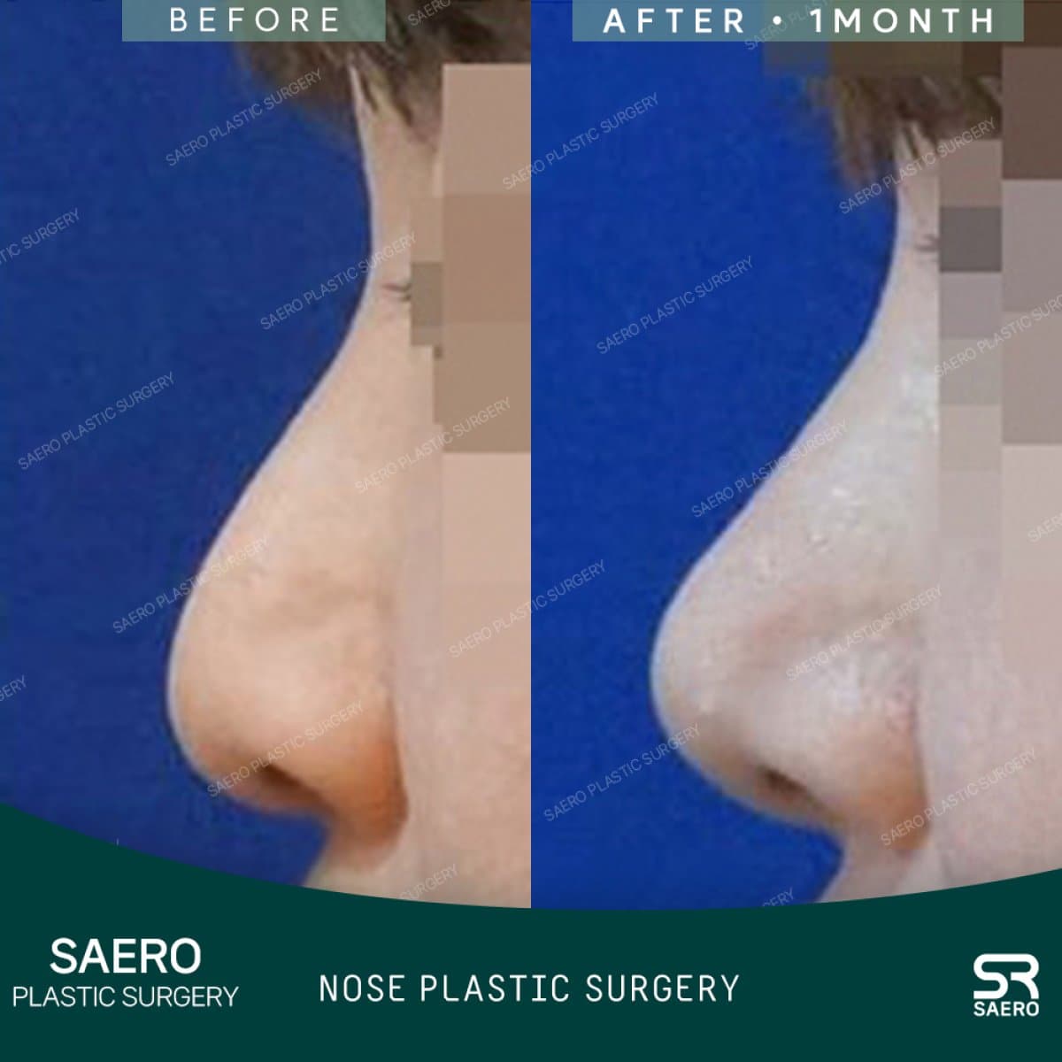 revision rhinoplasty