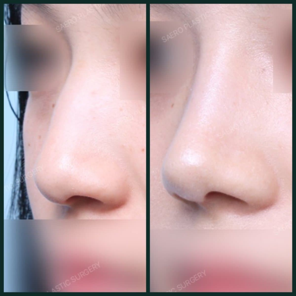 rhinoplasty