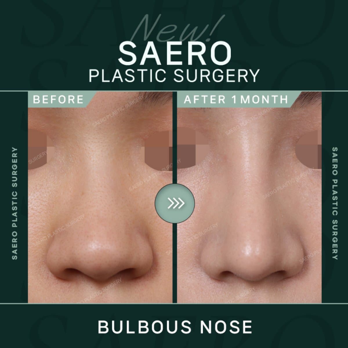 tip rhinoplasty for bulbous nose