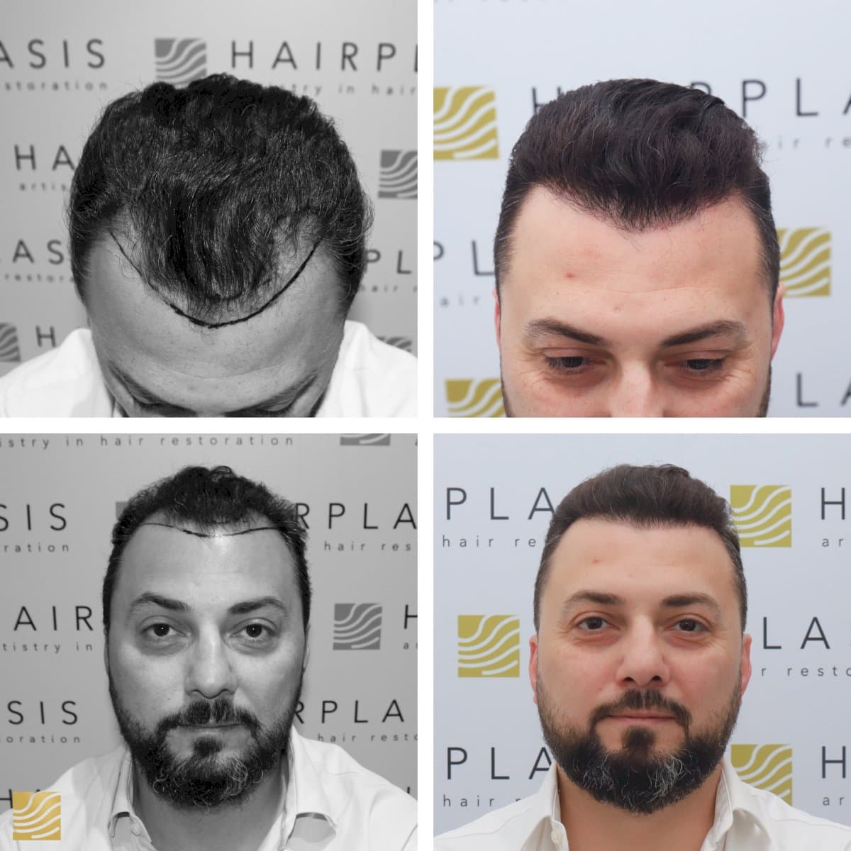 FUE hair transplant