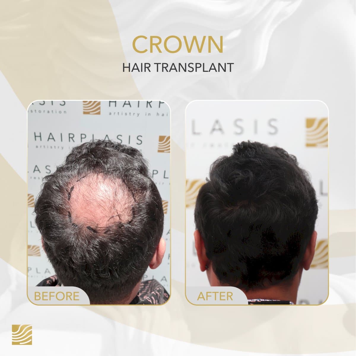 FUE crown hair transplant