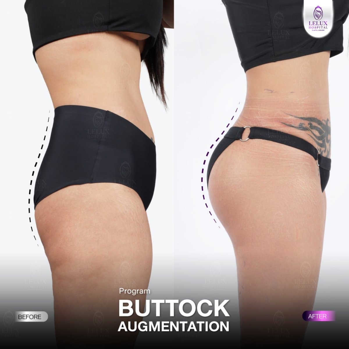 buttock augmentation