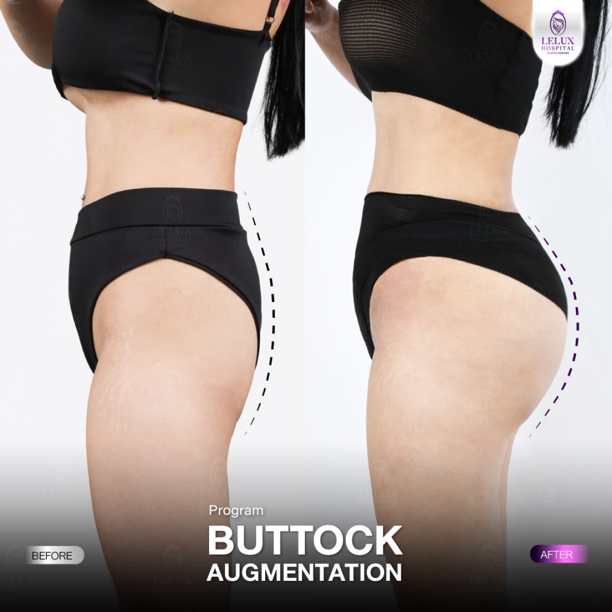 buttock augmentation