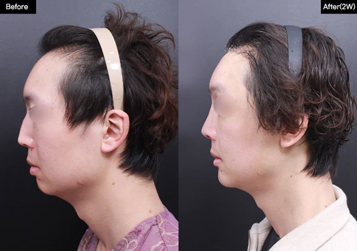 chin implant