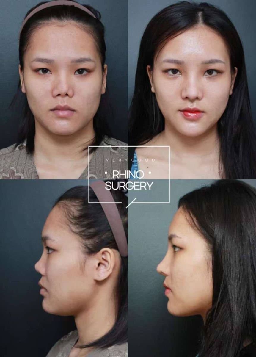 rhinoplasty