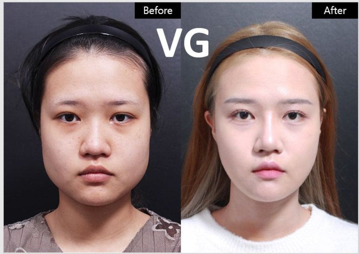 cheekbone reduction