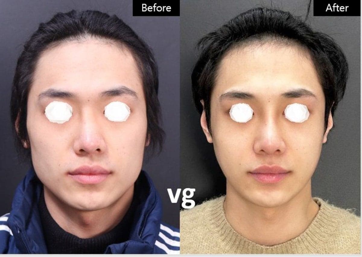 cheekbone reduction