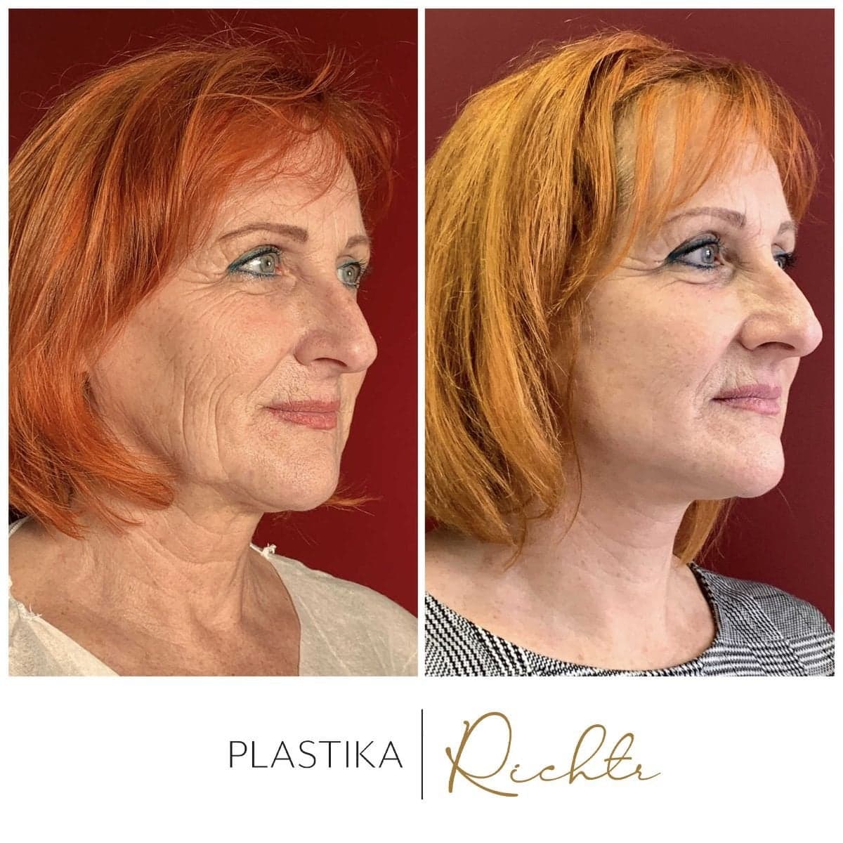 brow lift