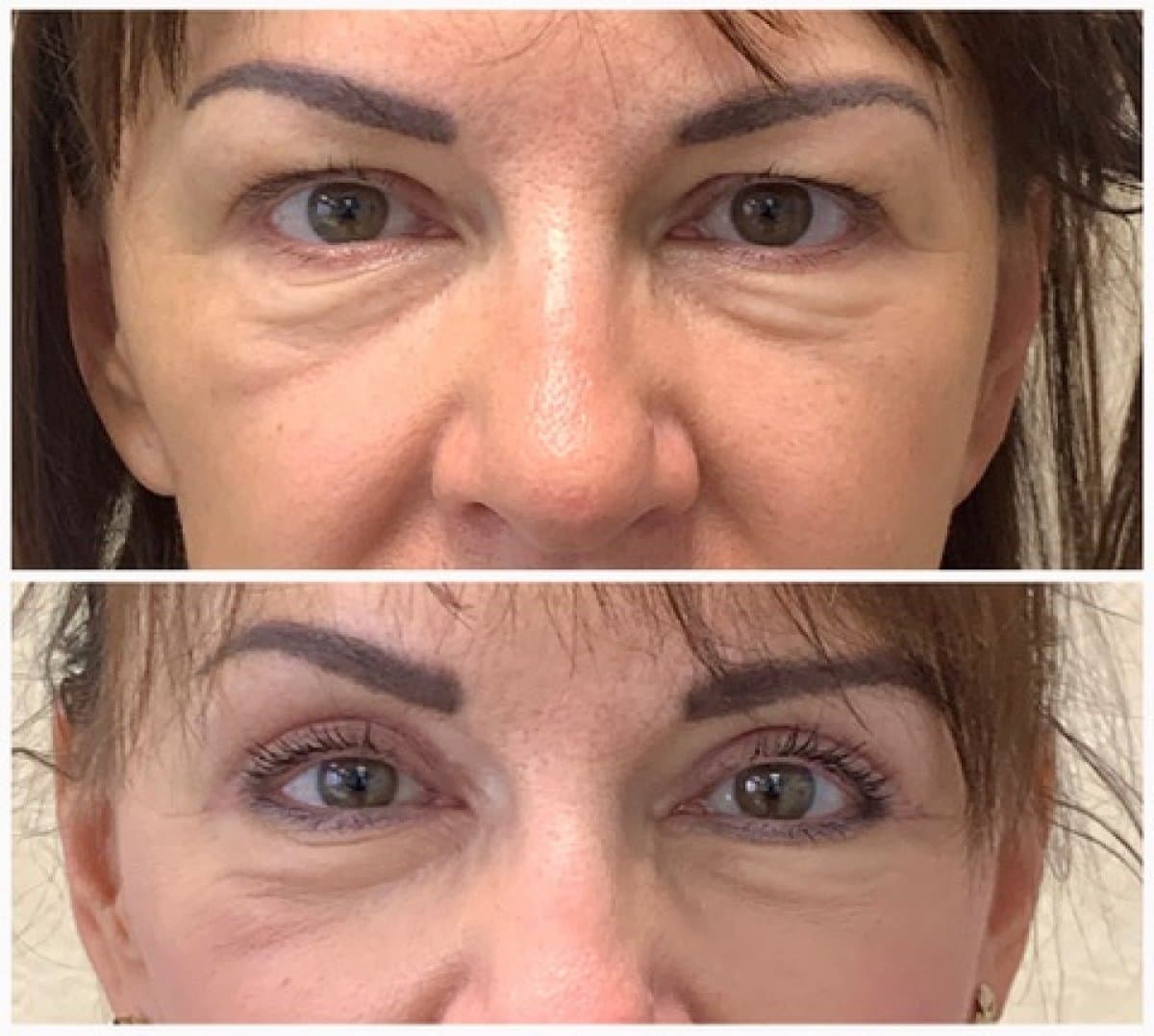 blepharoplasty