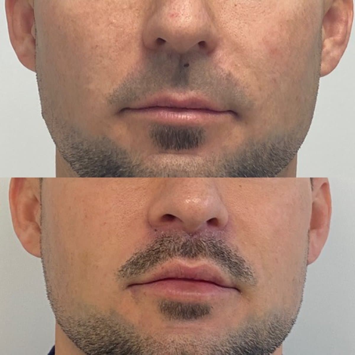 lip lift