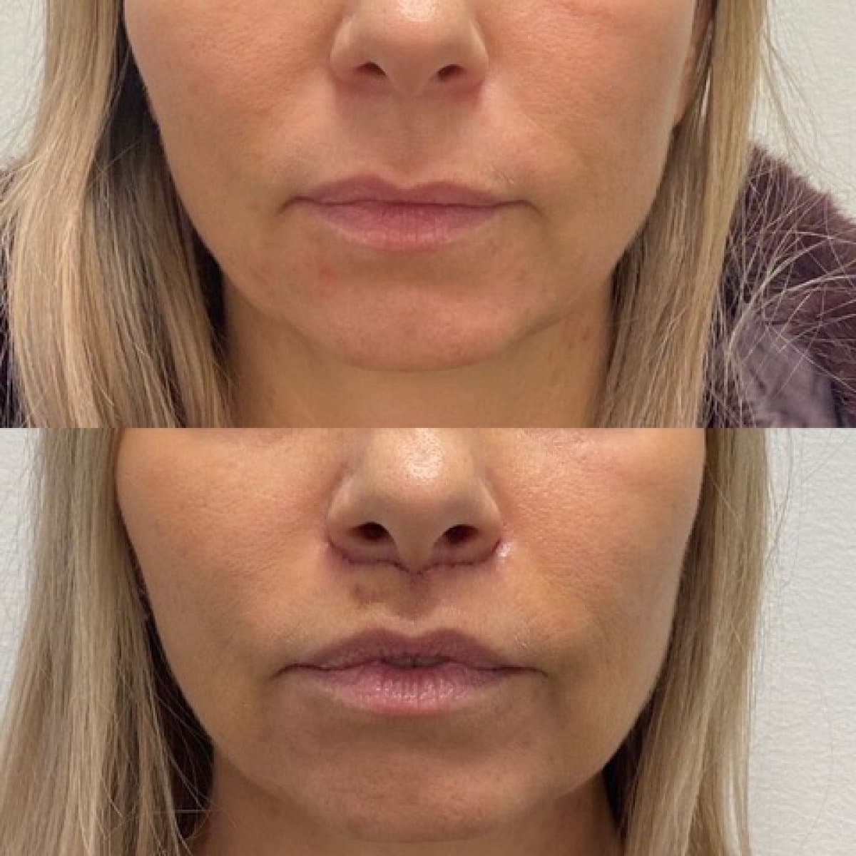 lip lift