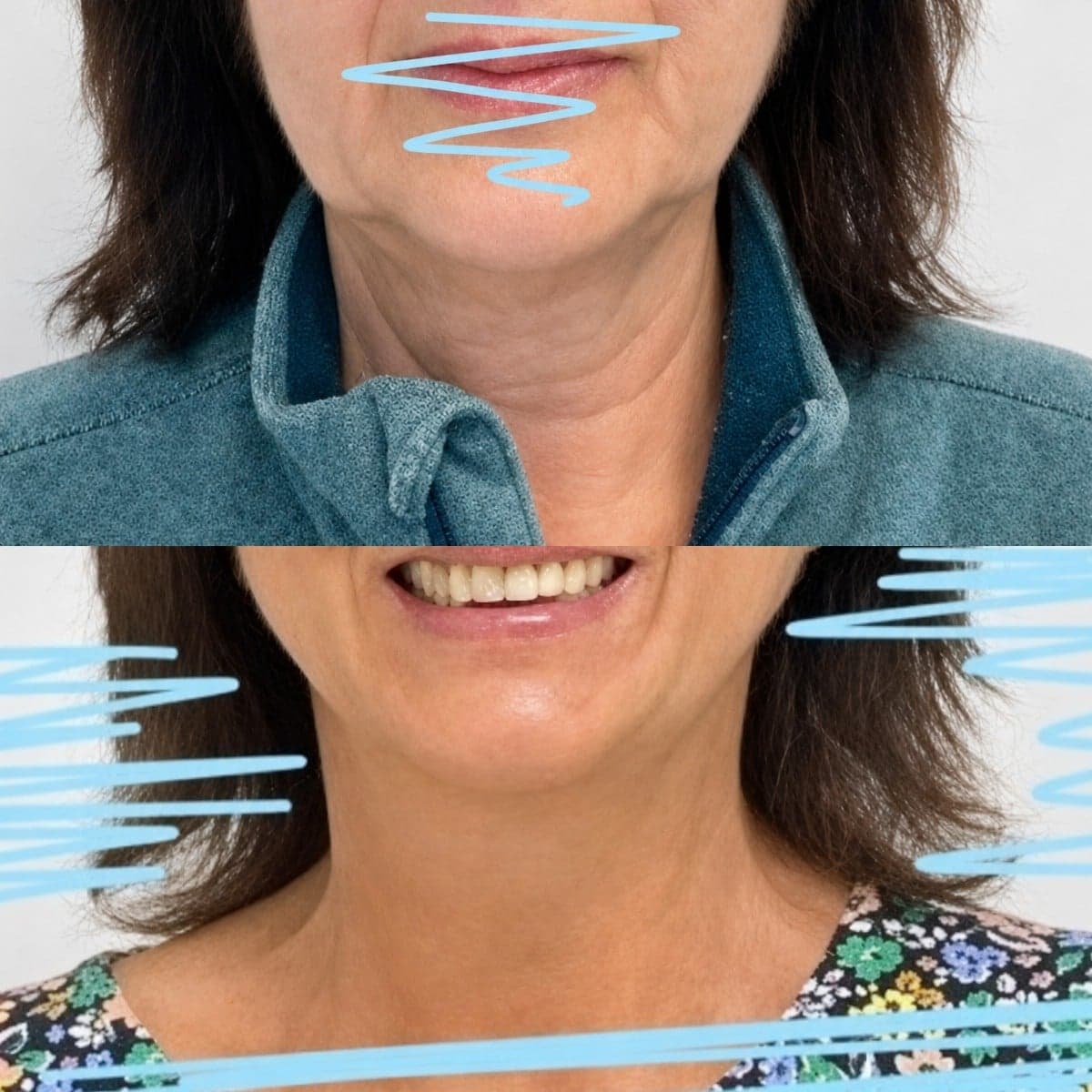 neck liposuction