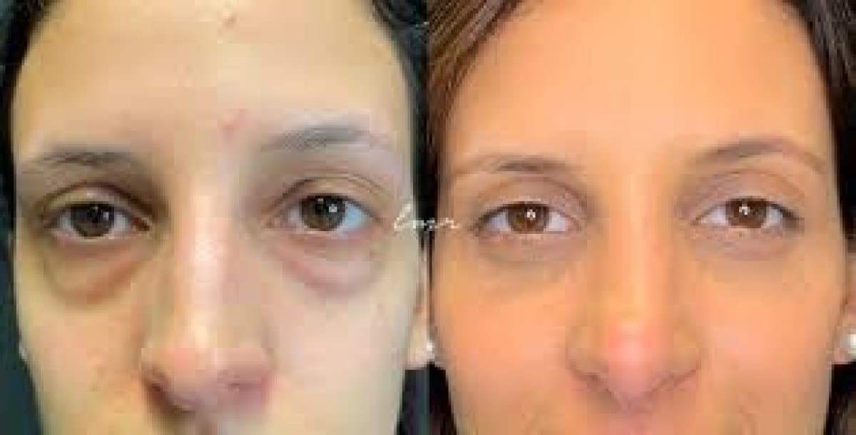 blepharoplasty