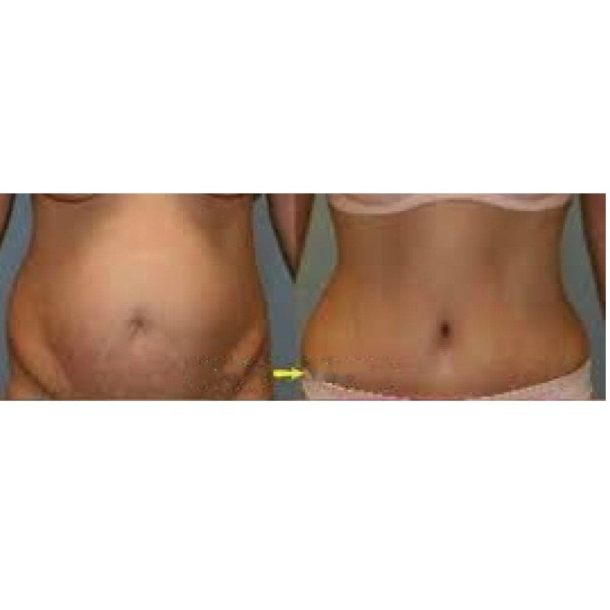 liposuction