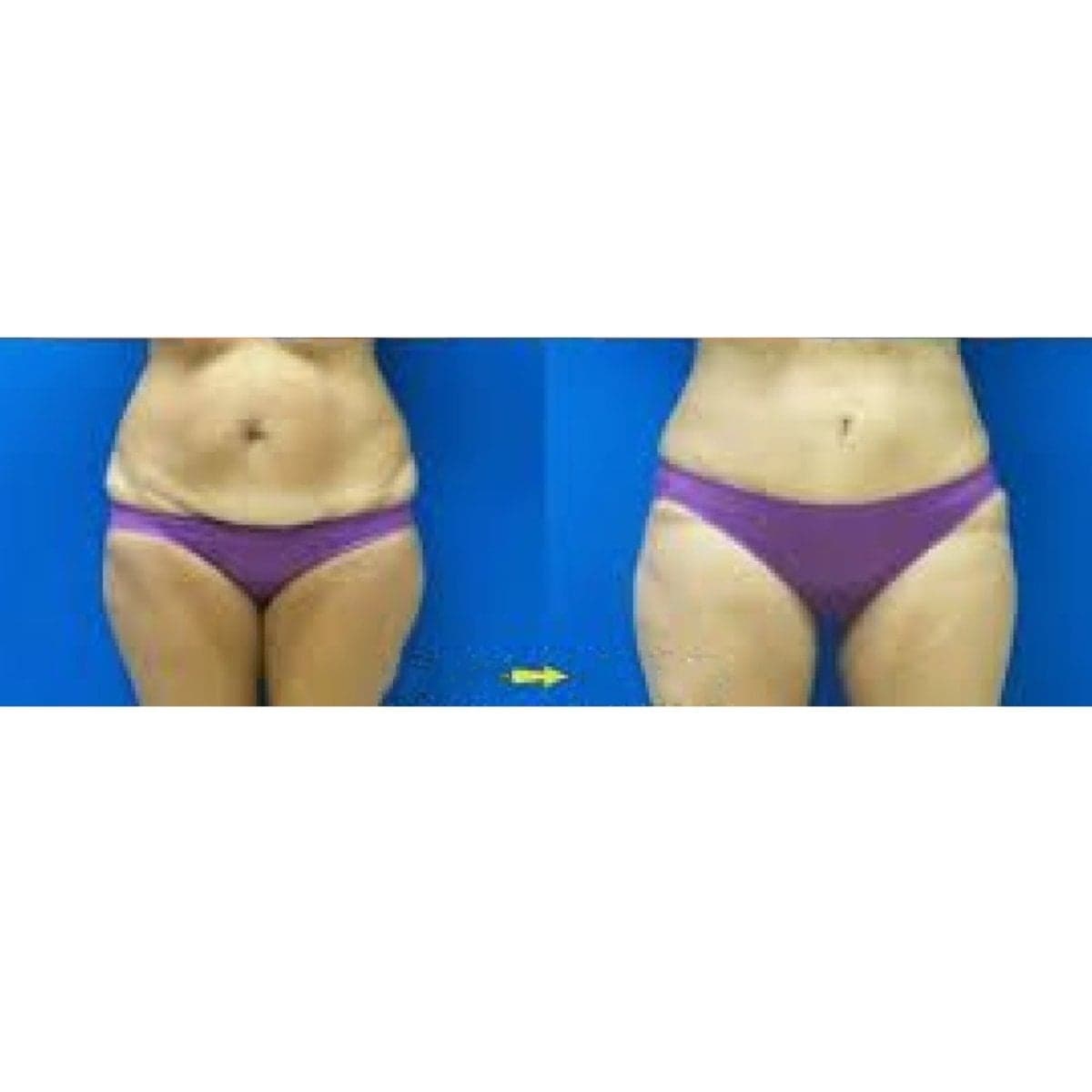 liposuction