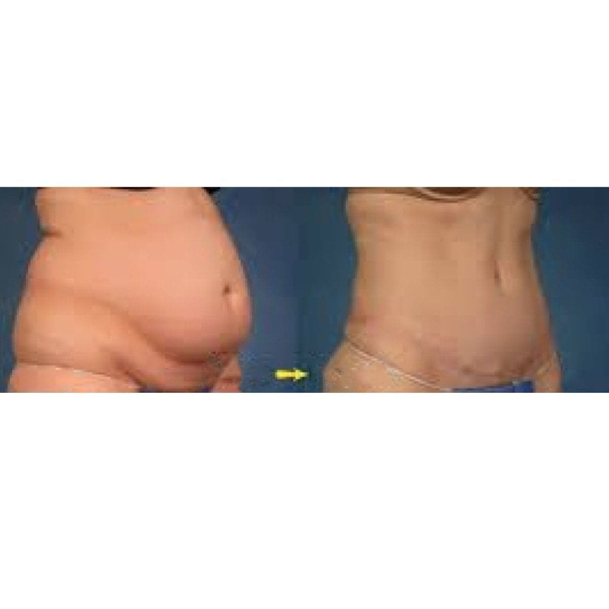 liposuction