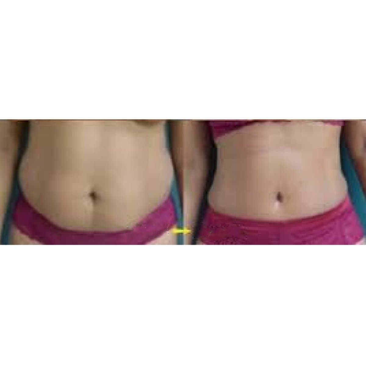 liposuction