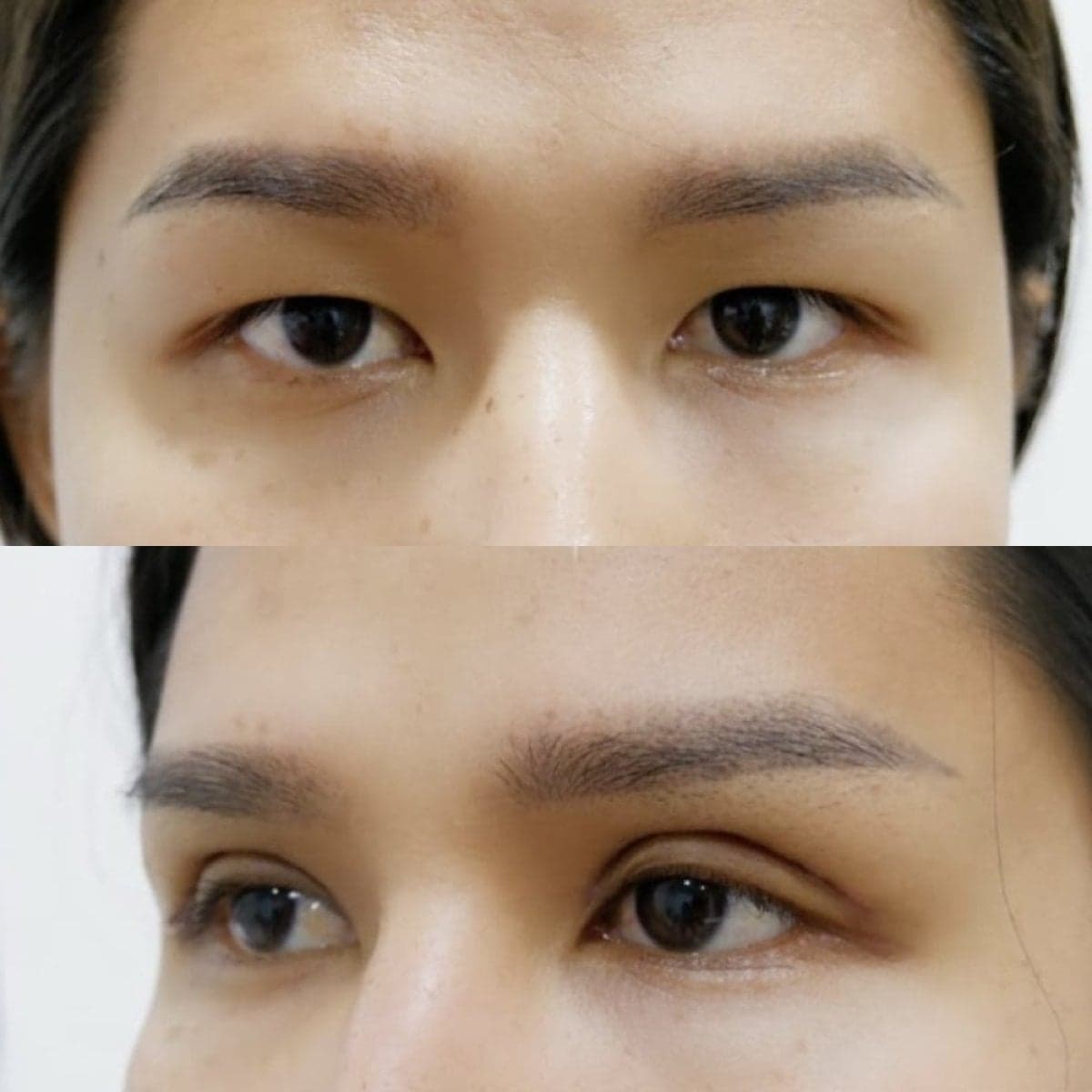blepharoplasty