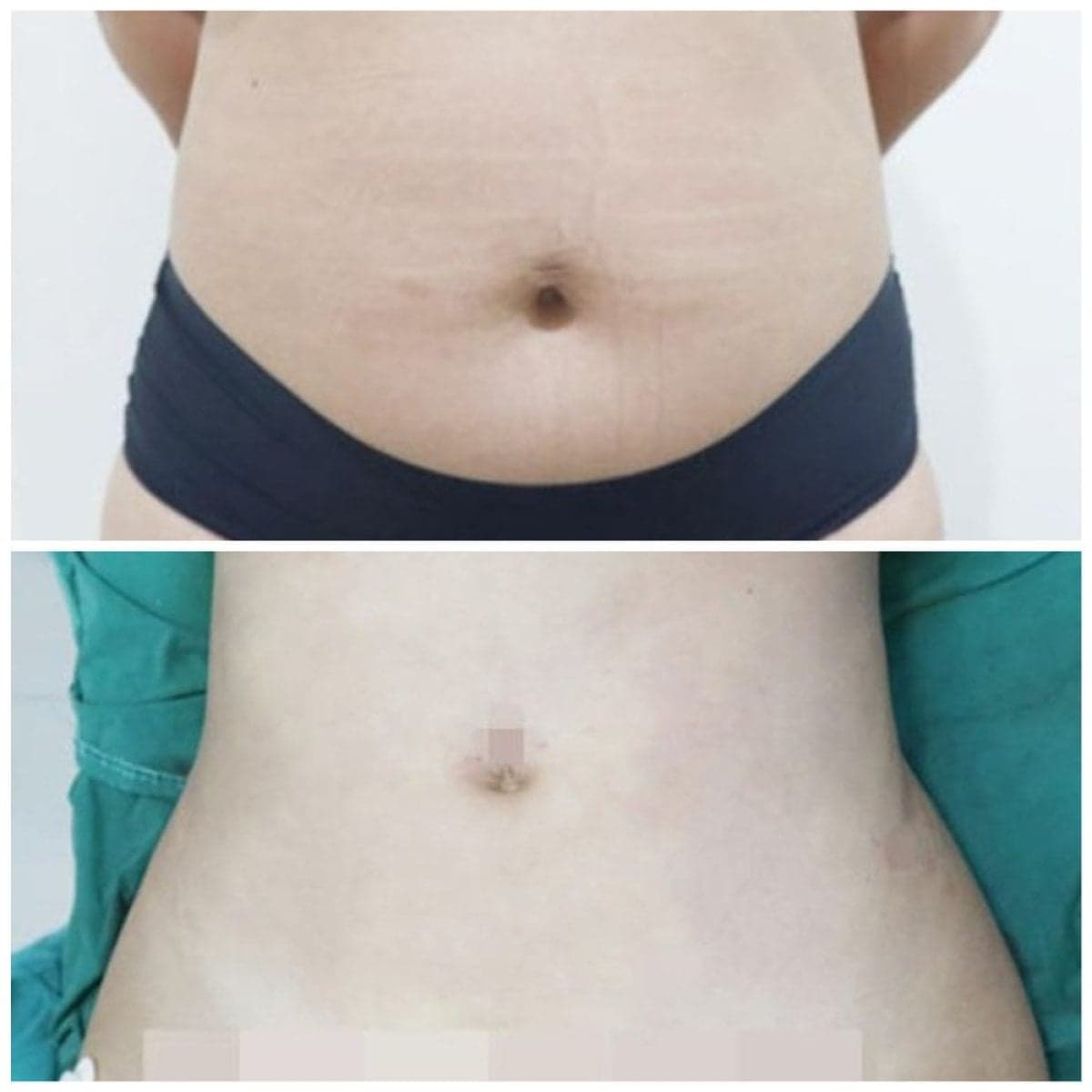 Vaser liposuction